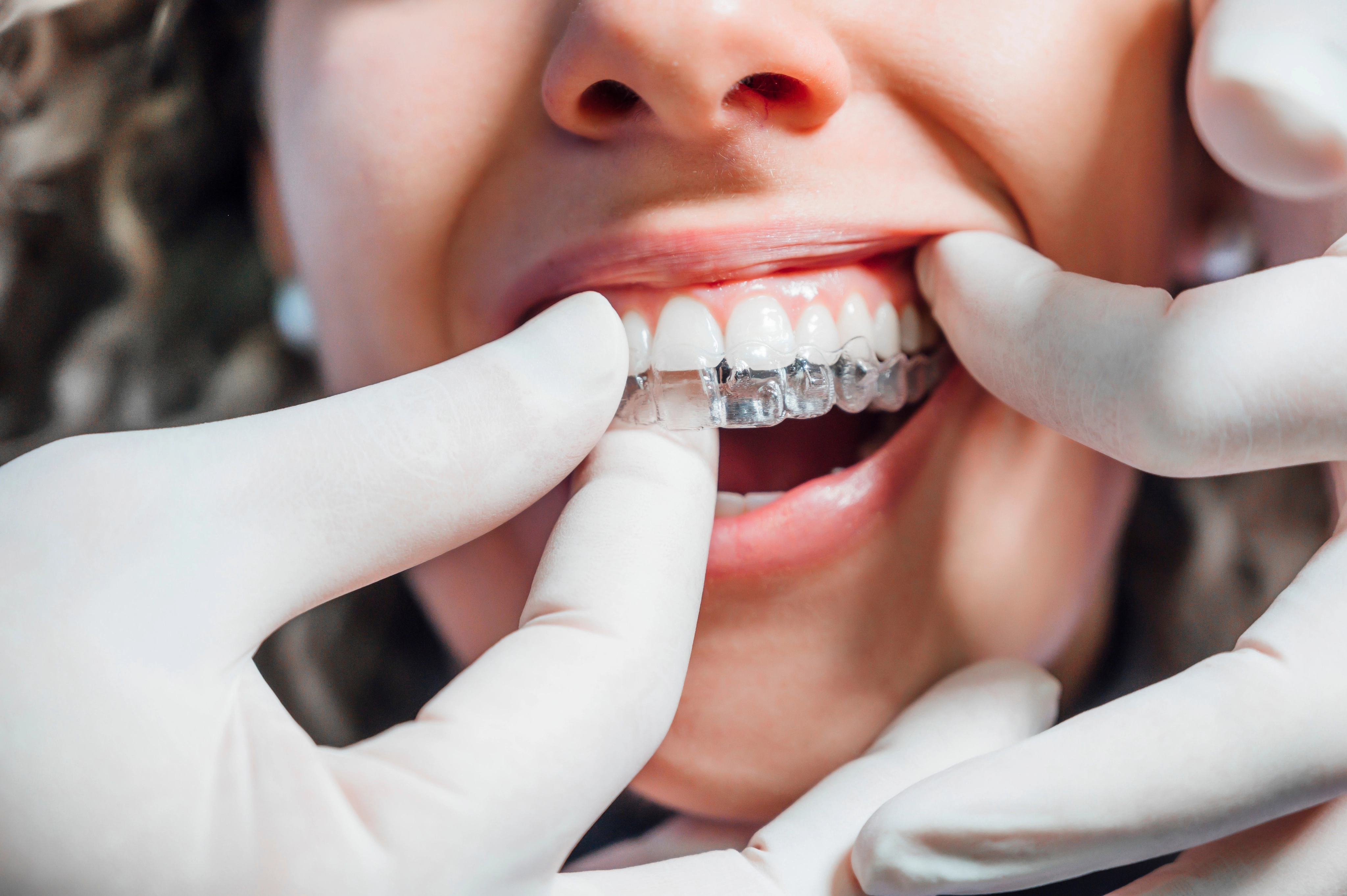 Clear Aligners in Greenwood, IN