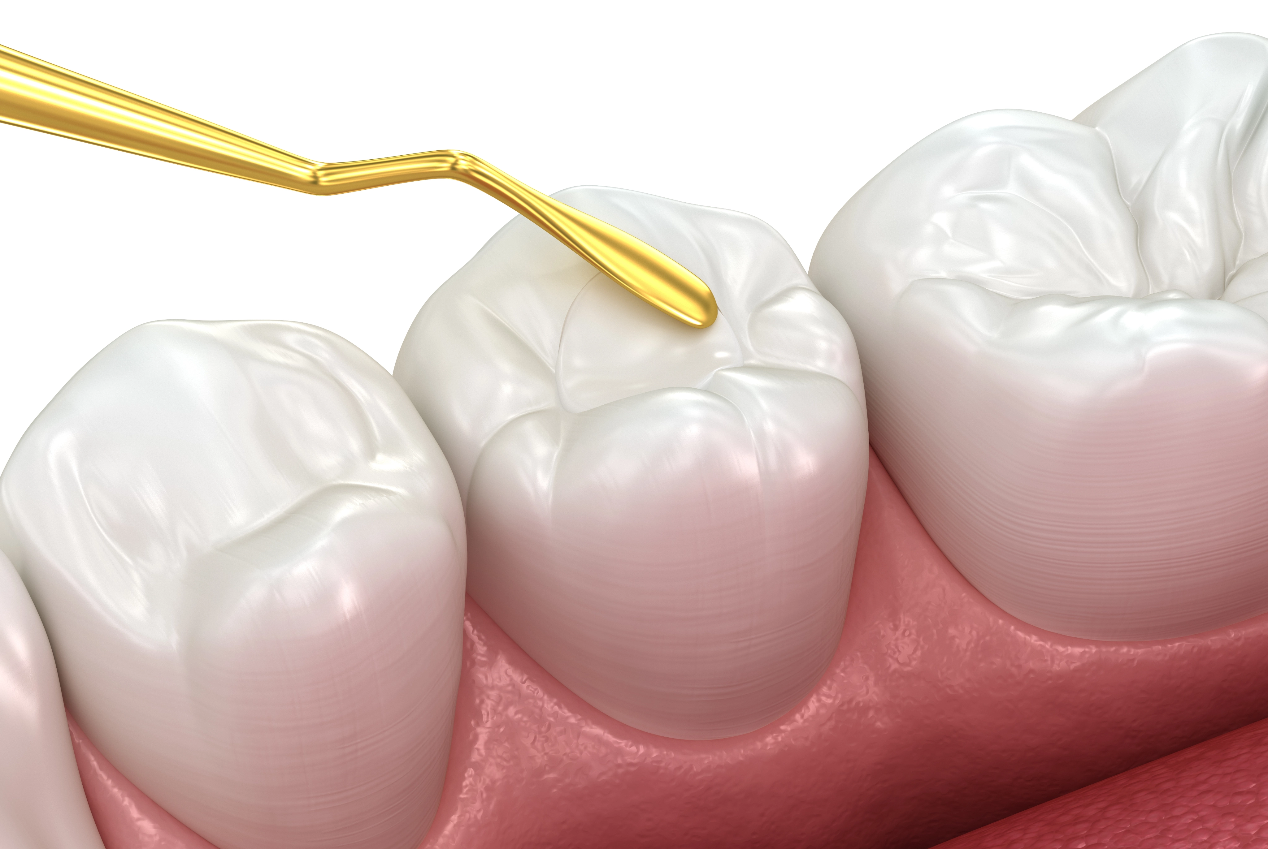 Composite Dental Fillings in Greenwood, IN