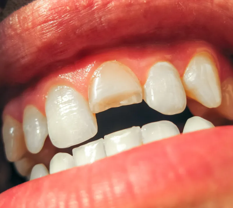 Restorative Dentistry in Greenwood, IN